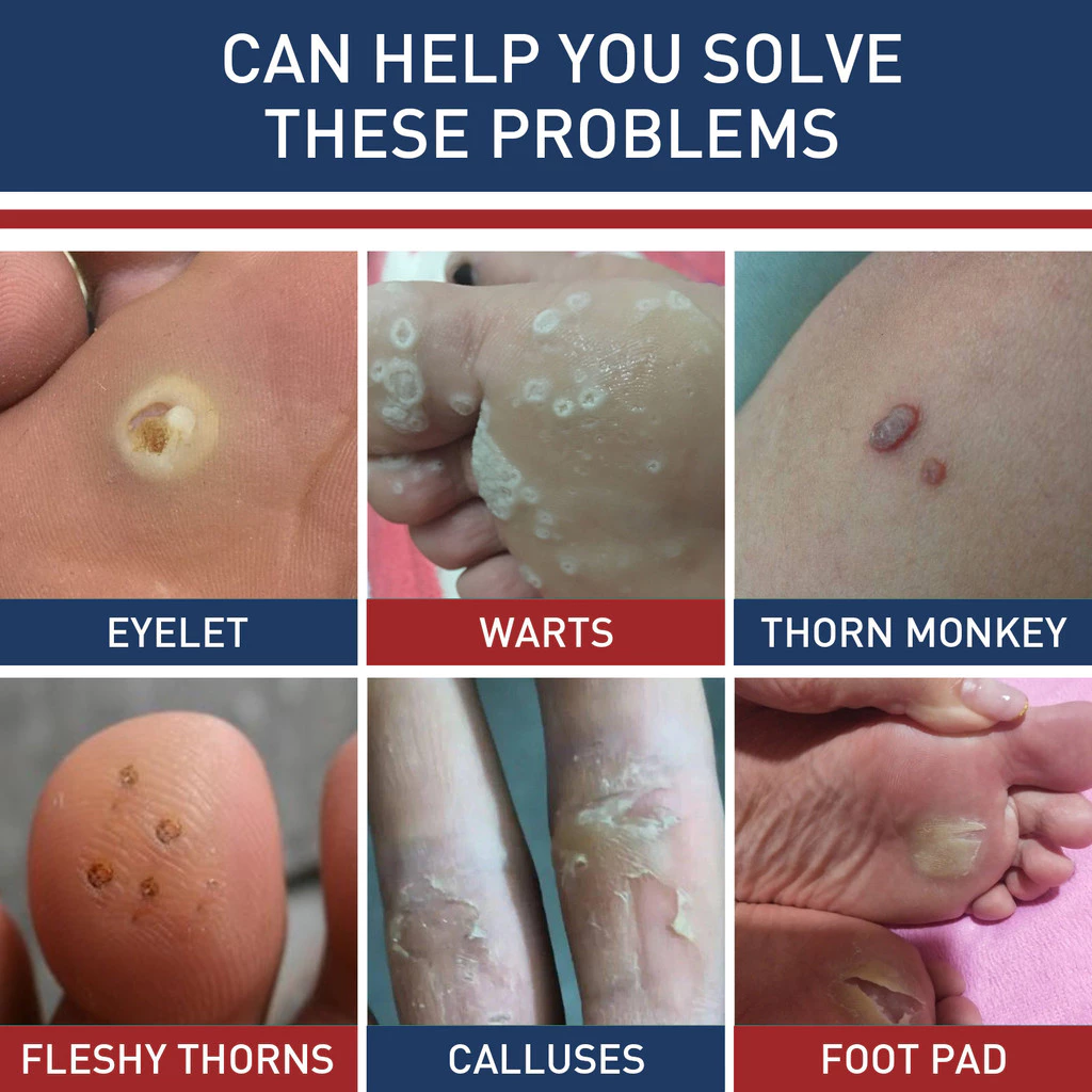 🩹 Corn Remover Pads (24pcs) – Pain Relief Foot Care Stickers 👣